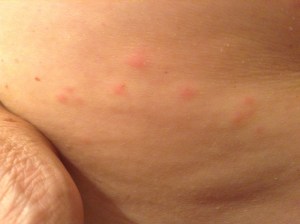 Very Itchy Rash